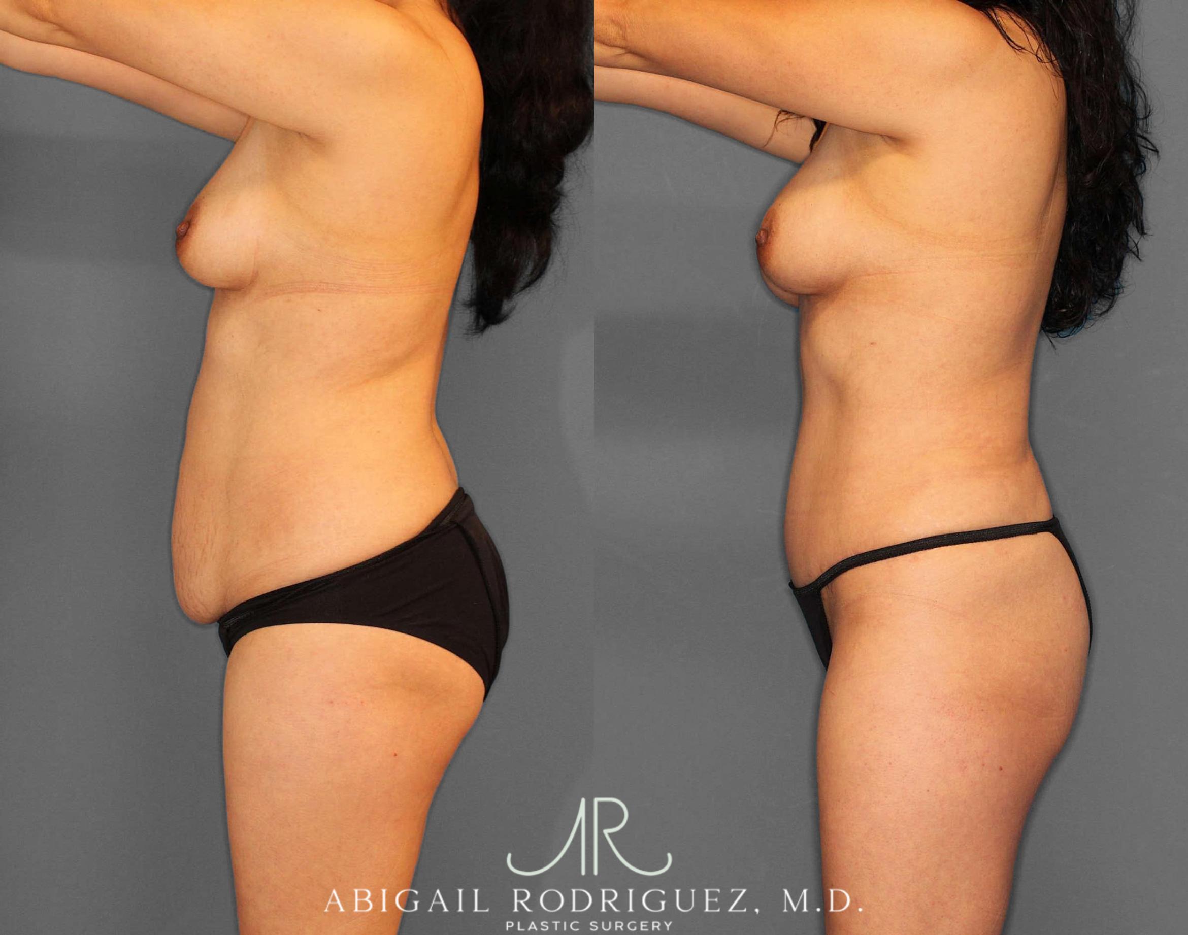 Before & After Tummy Tuck Case 254809 View 3 View in Houston, TX