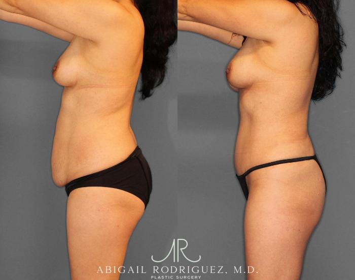 Before & After Tummy Tuck Case 254809 View 3 View in Houston, TX