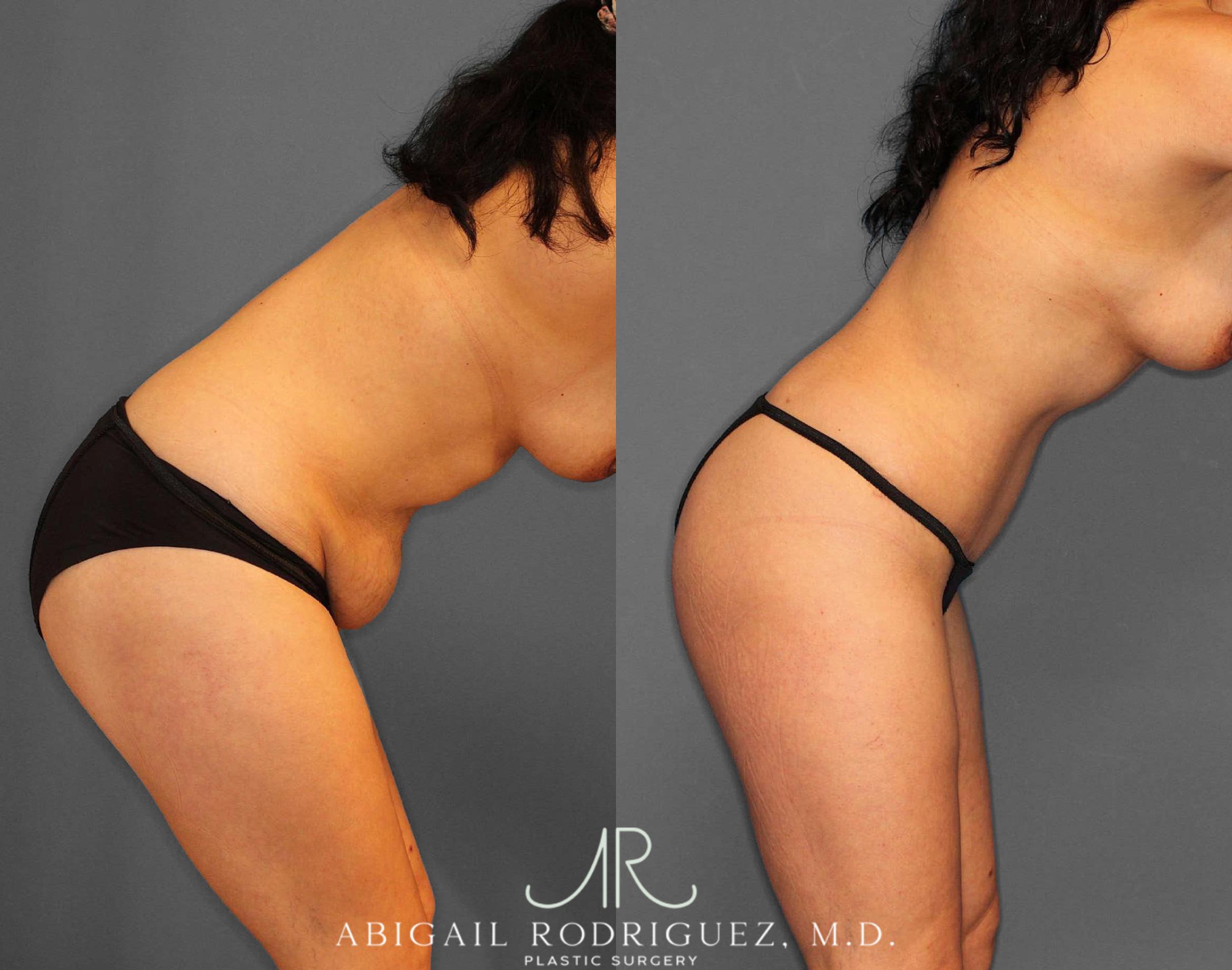 Before & After Tummy Tuck Case 254809 View 4 View in Houston, TX
