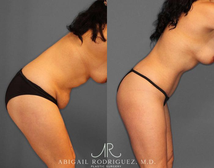 Before & After Tummy Tuck Case 254809 View 4 View in Houston, TX