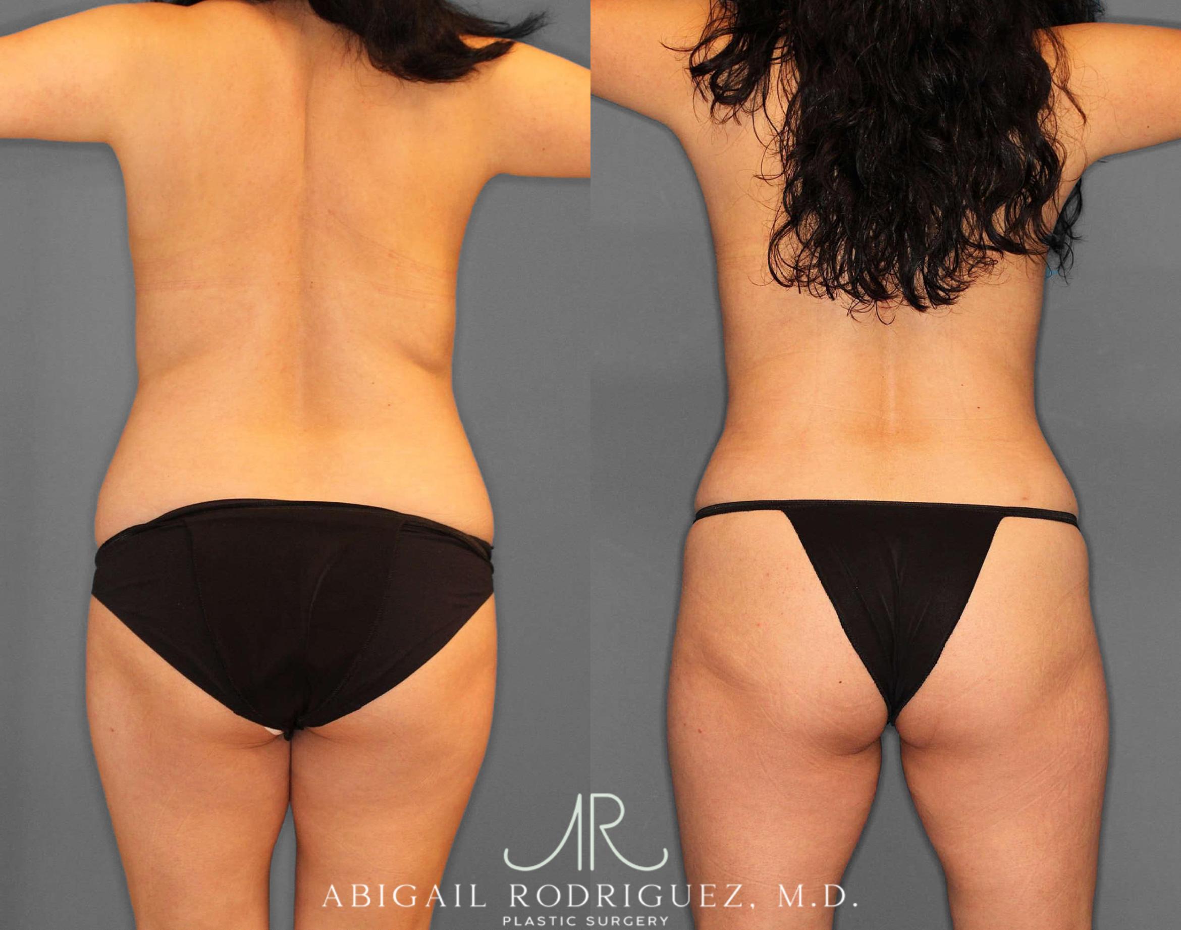 Before & After Tummy Tuck Case 254809 View 5 View in Houston, TX