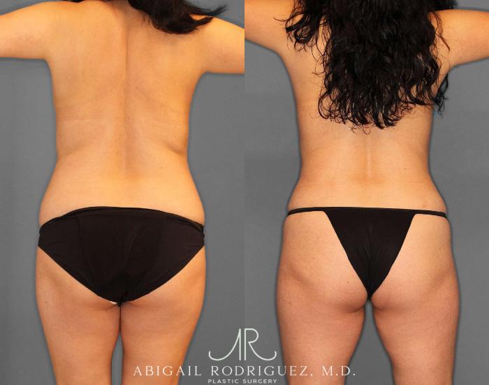 Before & After Tummy Tuck Case 254809 View 5 View in Houston, TX