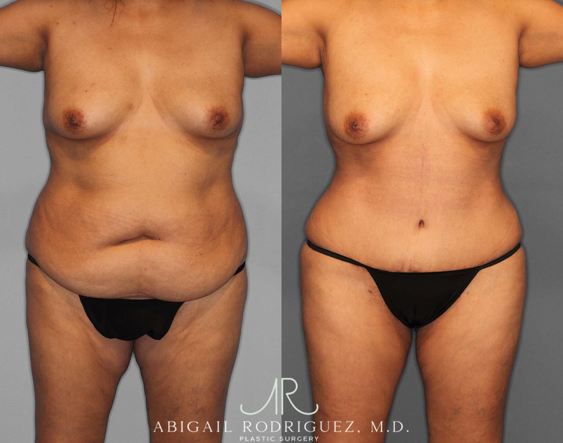 Before & After Tummy Tuck Case 254811 View 1 View in Houston, TX