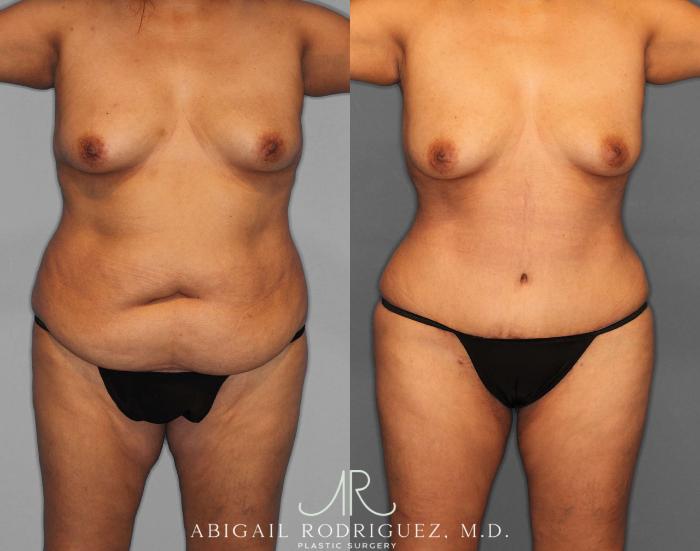 Before & After Fat Grafting Case 254811 View 1 View in Houston, TX