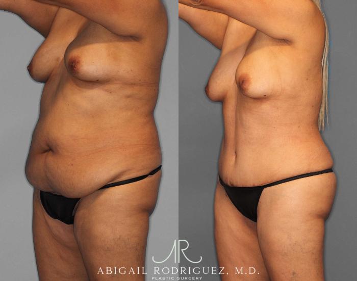 Before & After Tummy Tuck Case 254811 View 2 View in Houston, TX