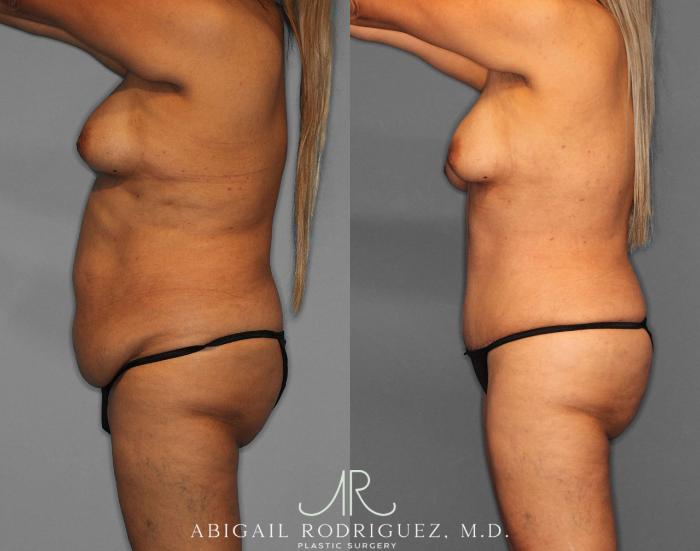 Before & After Tummy Tuck Case 254811 View 3 View in Houston, TX