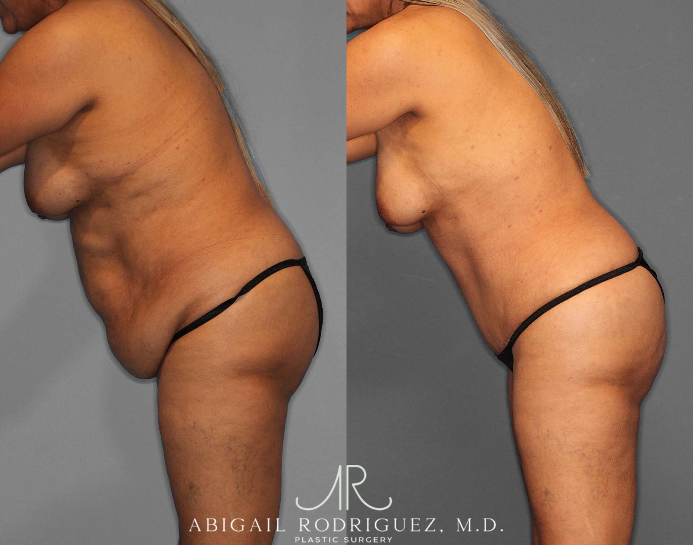 Before & After Tummy Tuck Case 254811 View 4 View in Houston, TX