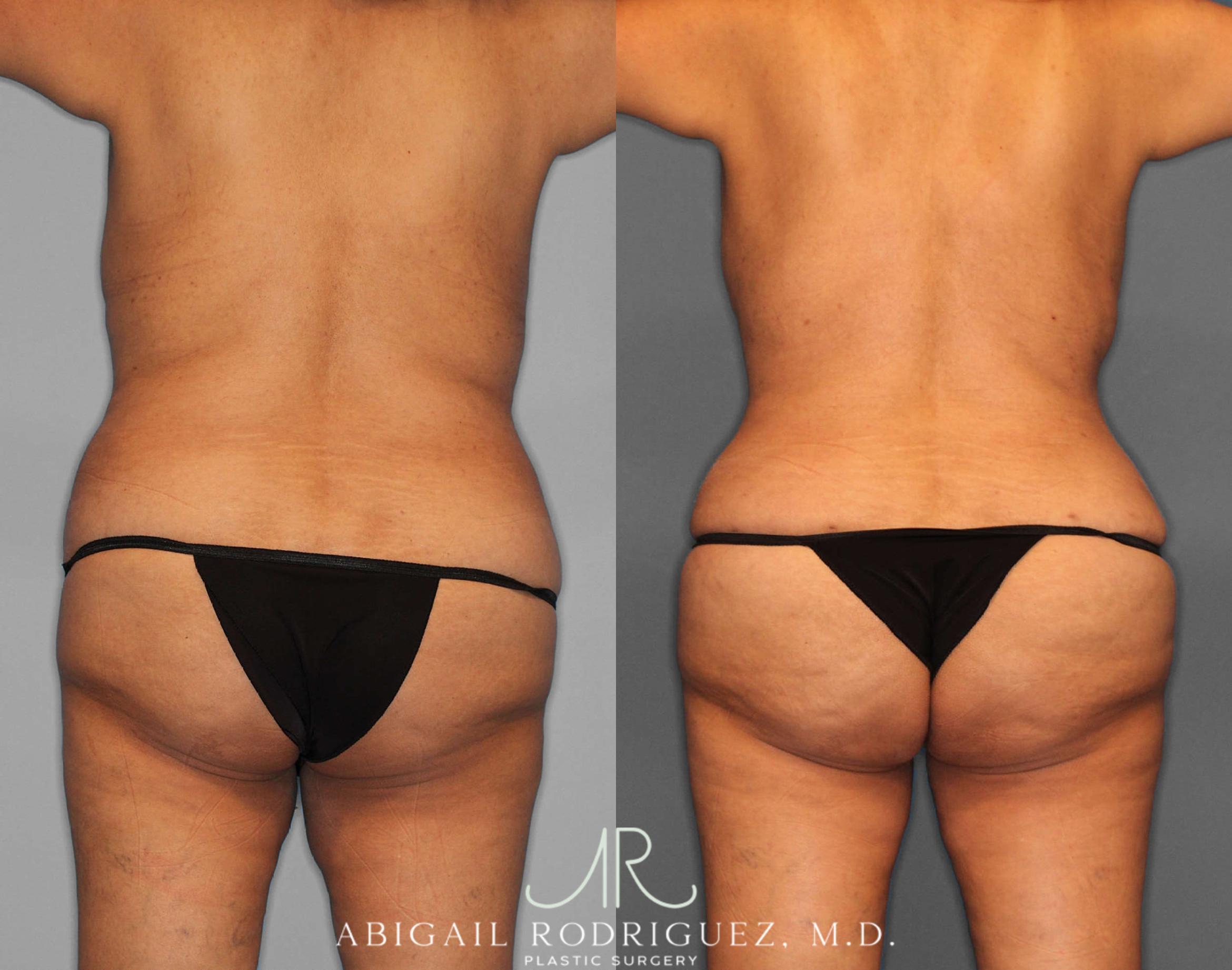 Before & After Tummy Tuck Case 254811 View 5 View in Houston, TX