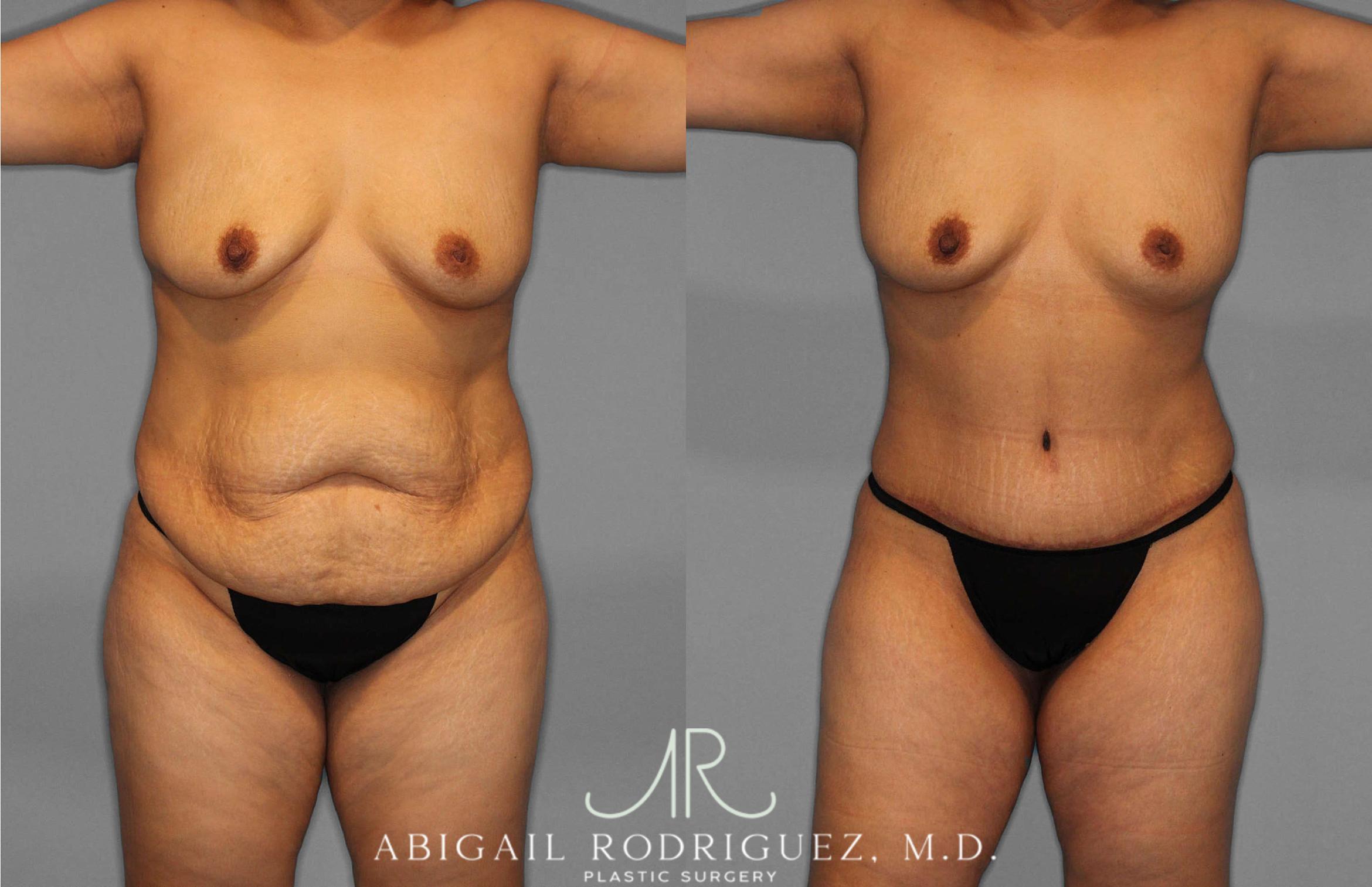 Before & After Tummy Tuck Case 254836 View 1 View in Houston, TX