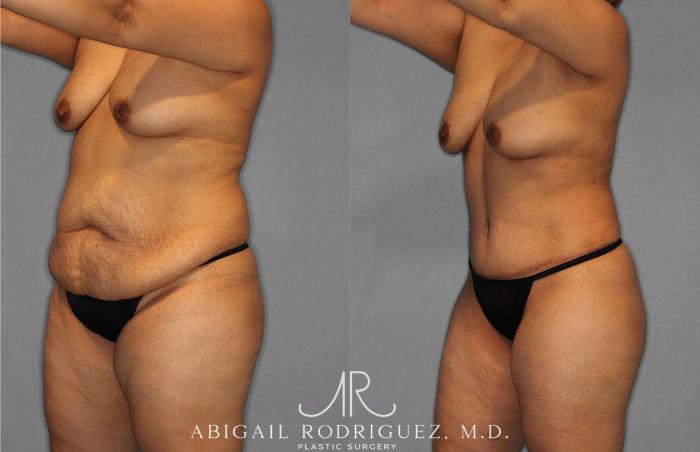 Before & After Tummy Tuck Case 254836 View 2 View in Houston, TX