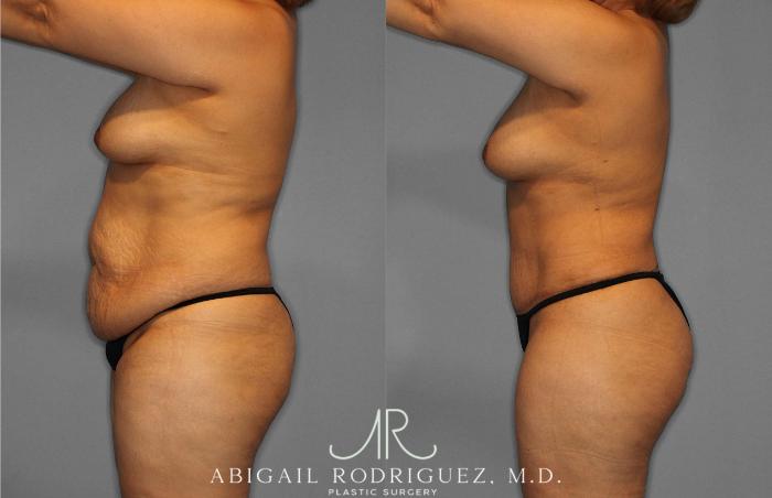 Before & After Tummy Tuck Case 254836 View 3 View in Houston, TX