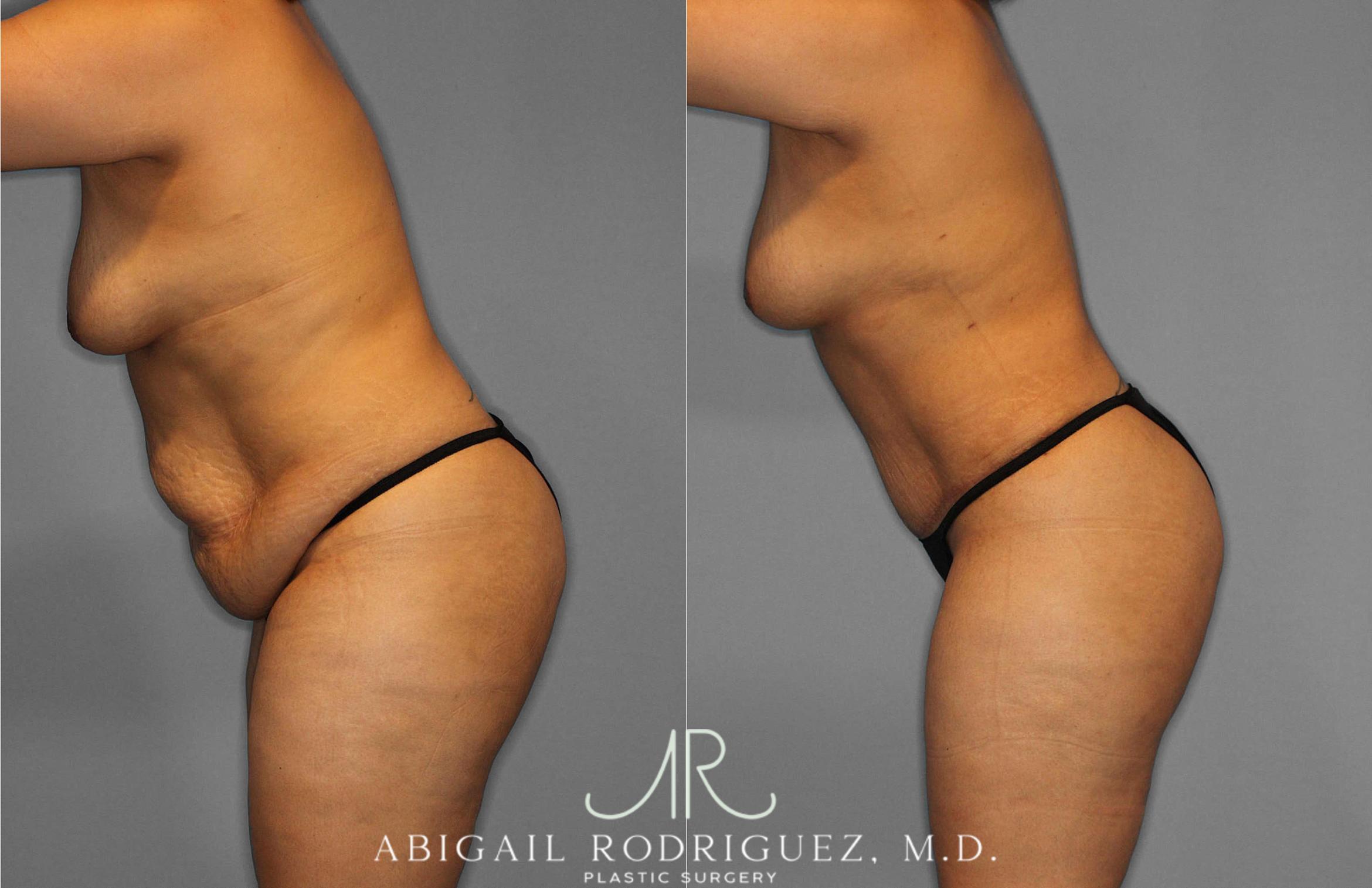 Before & After Tummy Tuck Case 254836 View 4 View in Houston, TX