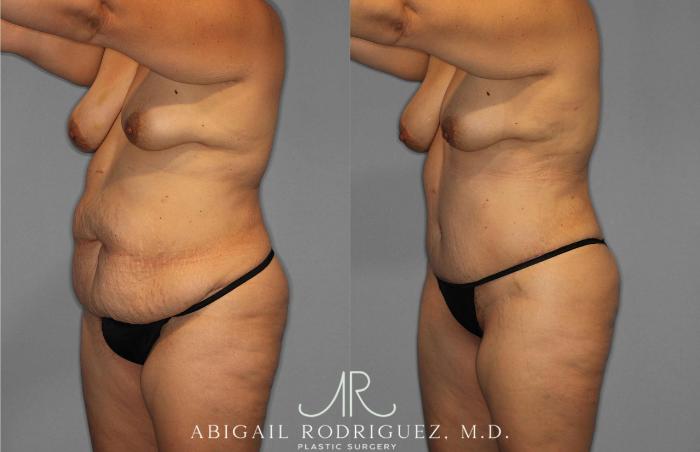 Before & After Tummy Tuck Case 254838 View 2 View in Houston, TX