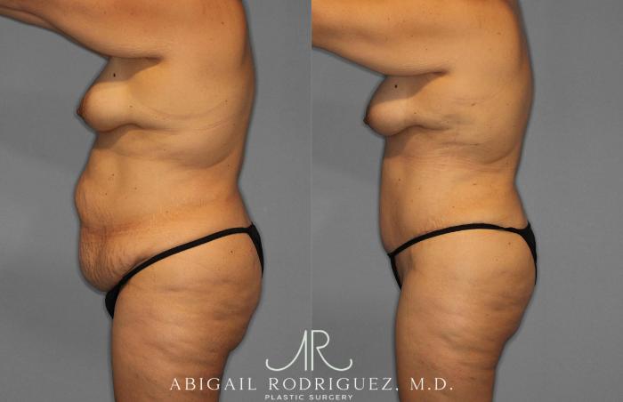Before & After Tummy Tuck Case 254838 View 3 View in Houston, TX