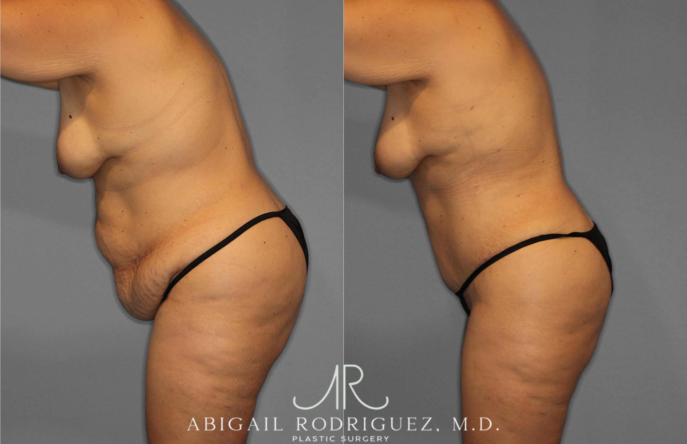 Before & After Tummy Tuck Case 254838 View 4 View in Houston, TX