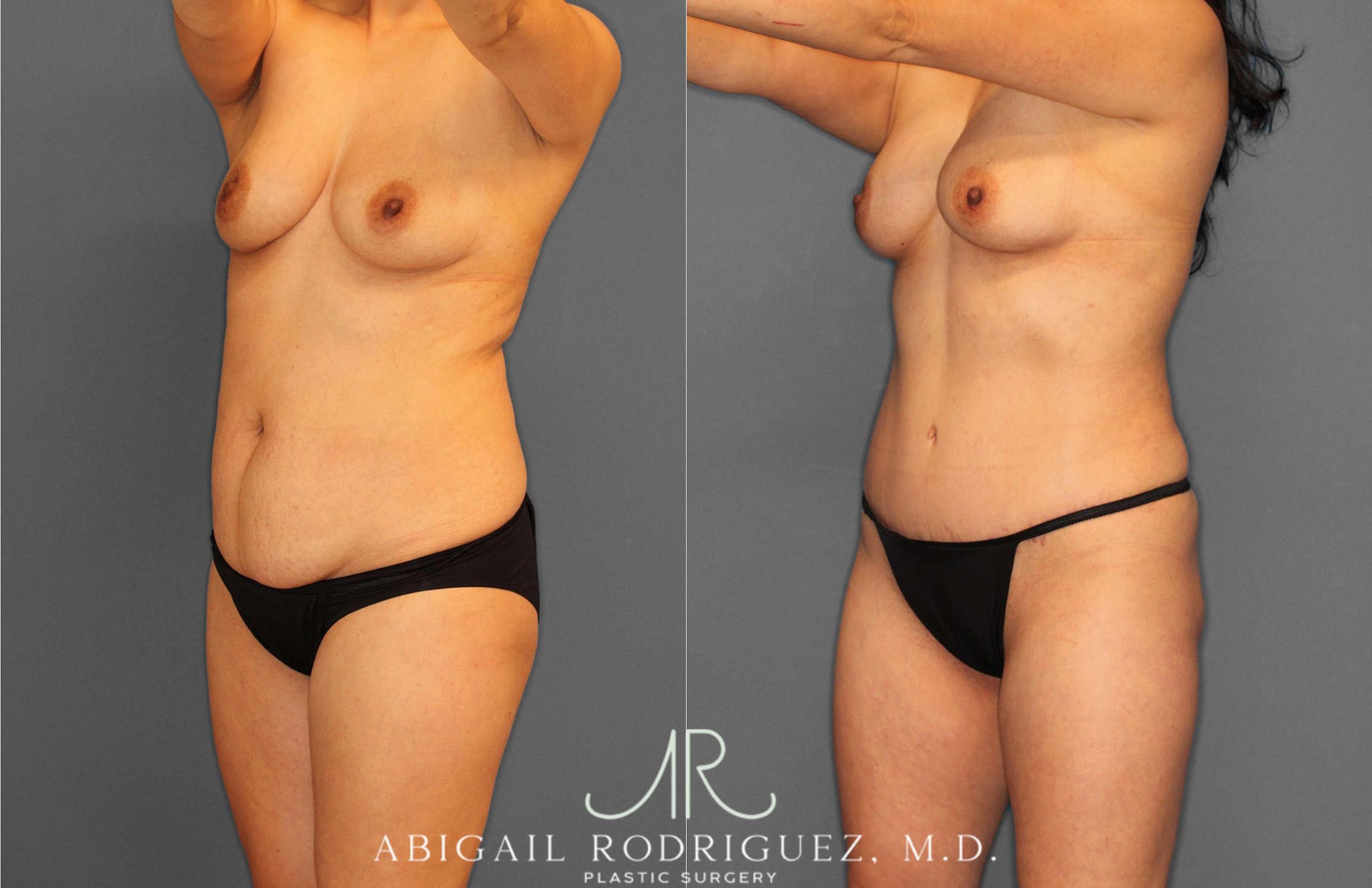 Before & After Tummy Tuck Case 254862 View 2 View in Houston, TX