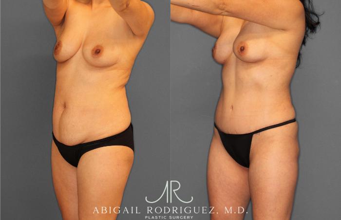 Before & After Tummy Tuck Case 254862 View 2 View in Houston, TX