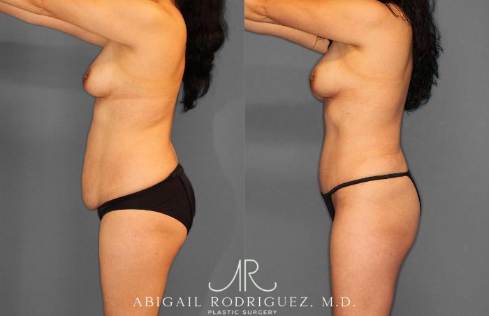 Before & After Tummy Tuck Case 254862 View 3 View in Houston, TX
