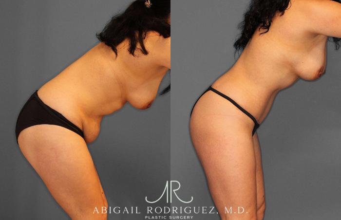Before & After Tummy Tuck Case 254862 View 4 View in Houston, TX
