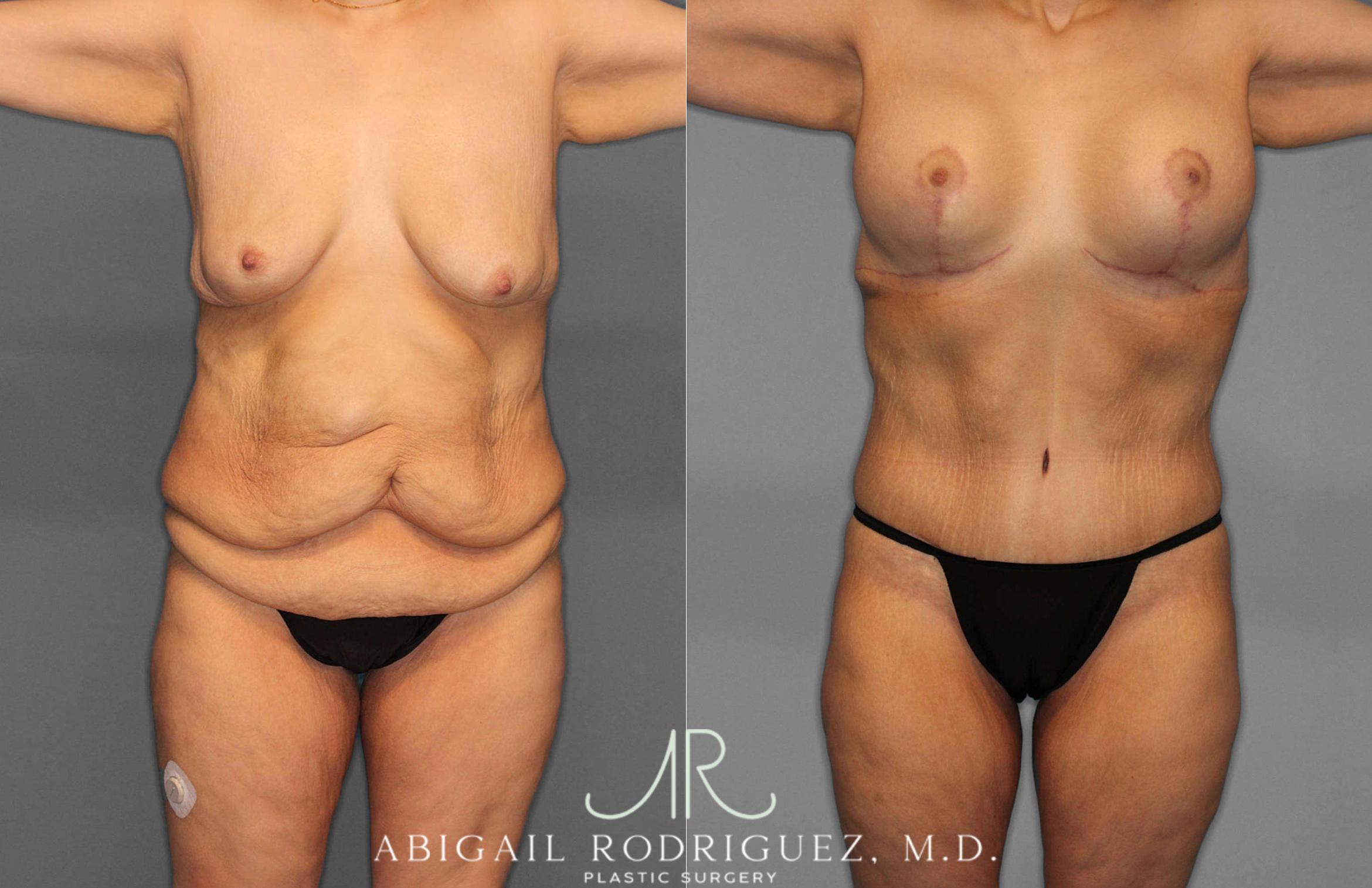 Before & After Tummy Tuck Case 254863 View 1 View in Houston, TX