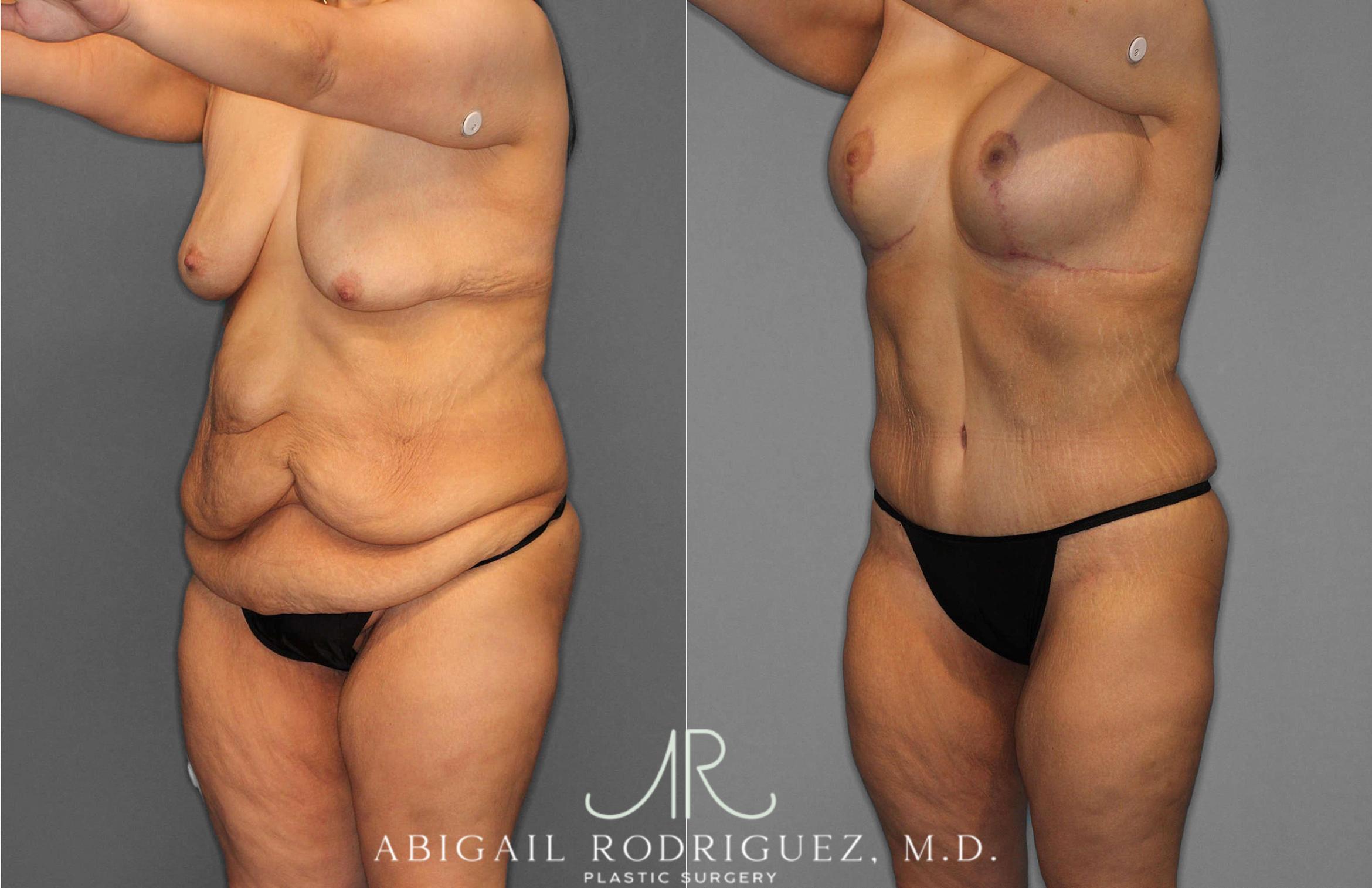 Before & After Tummy Tuck Case 254863 View 2 View in Houston, TX