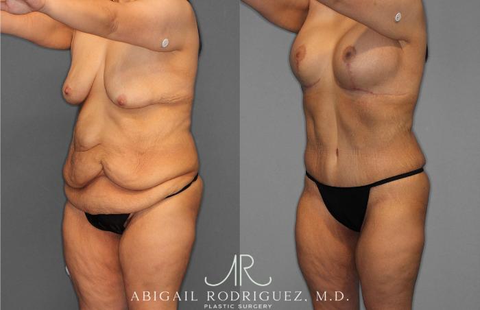 Before & After Tummy Tuck Case 254863 View 2 View in Houston, TX