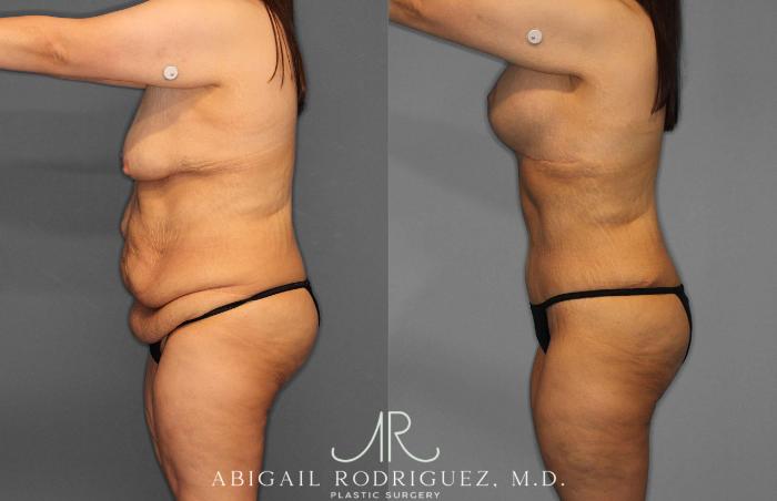 Before & After Tummy Tuck Case 254863 View 3 View in Houston, TX