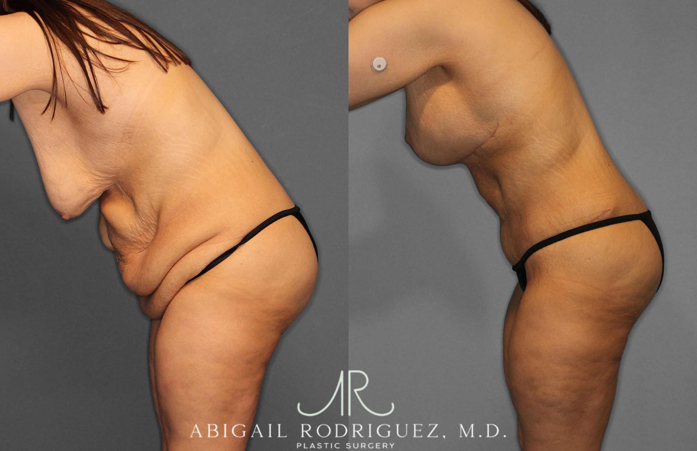 Before & After Tummy Tuck Case 254863 View 4 View in Houston, TX