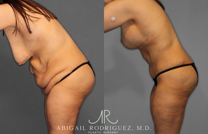 Before & After Tummy Tuck Case 254863 View 4 View in Houston, TX