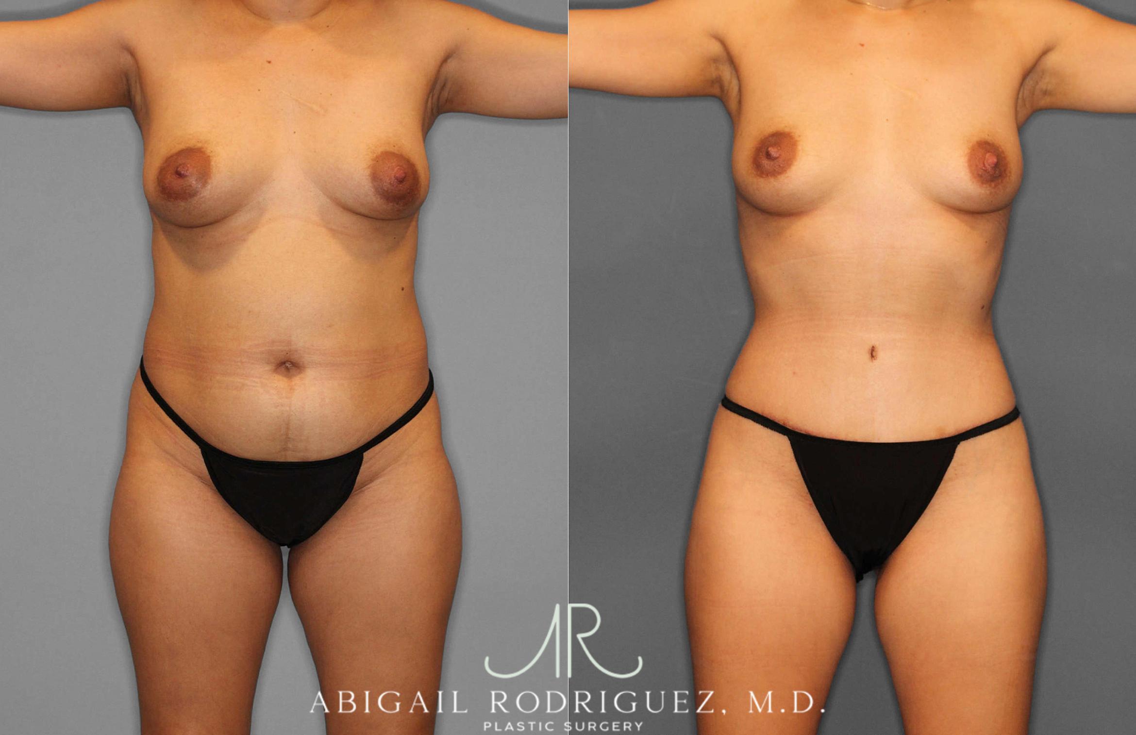 Before & After Tummy Tuck Case 254864 View 1 View in Houston, TX