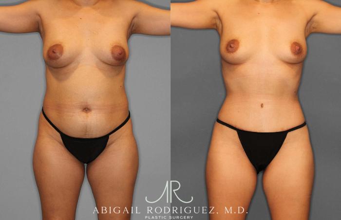 Before & After Tummy Tuck Case 254864 View 1 View in Houston, TX