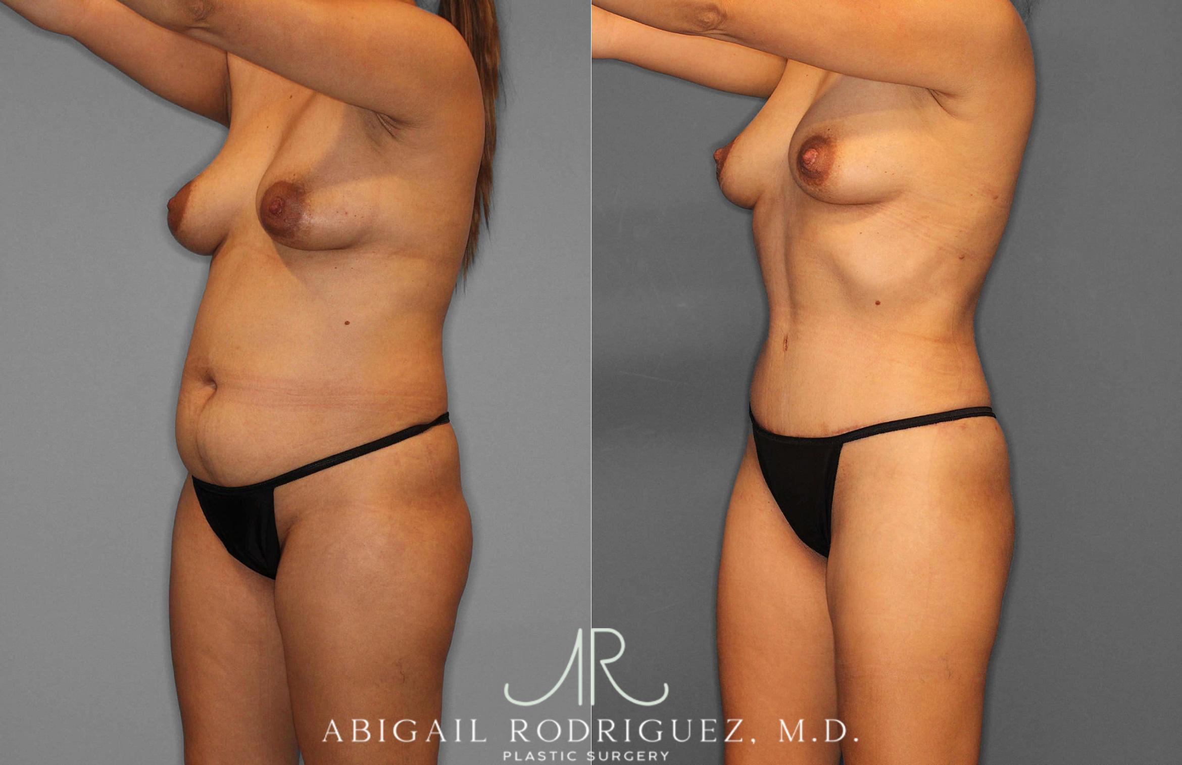 Before & After Tummy Tuck Case 254864 View 2 View in Houston, TX