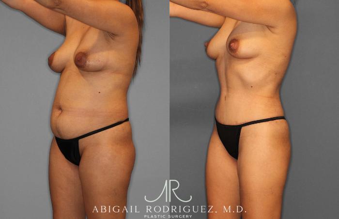 Before & After Tummy Tuck Case 254864 View 2 View in Houston, TX