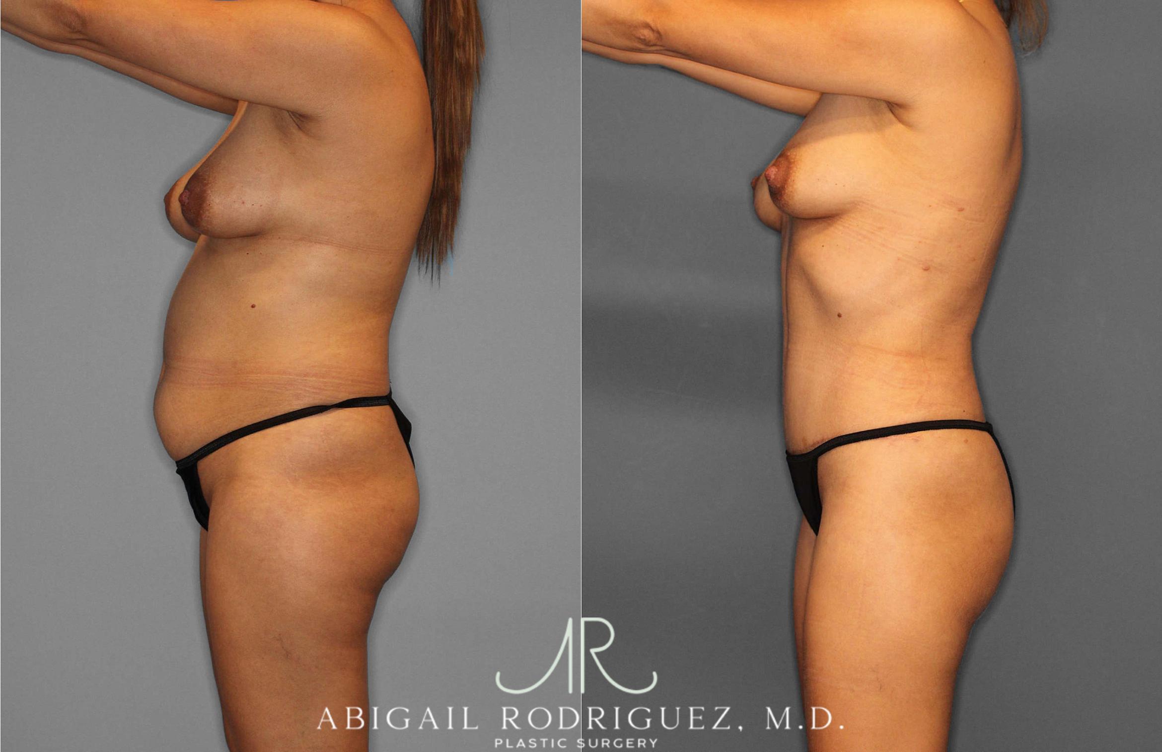 Before & After Tummy Tuck Case 254864 View 3 View in Houston, TX