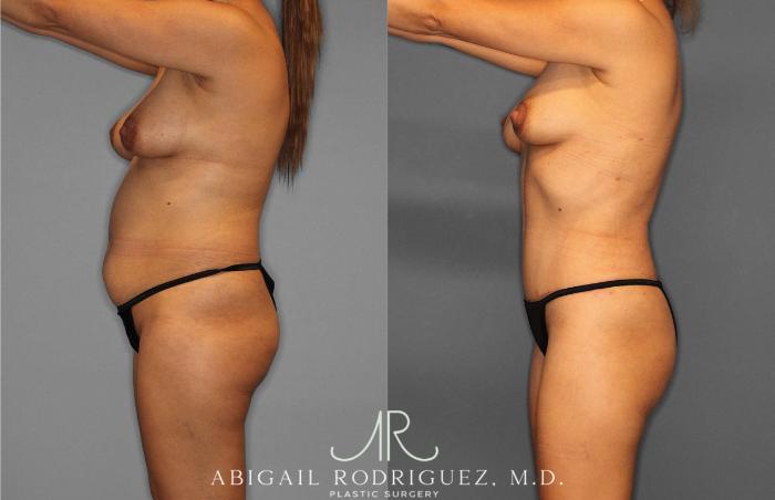 Before & After Tummy Tuck Case 254864 View 3 View in Houston, TX