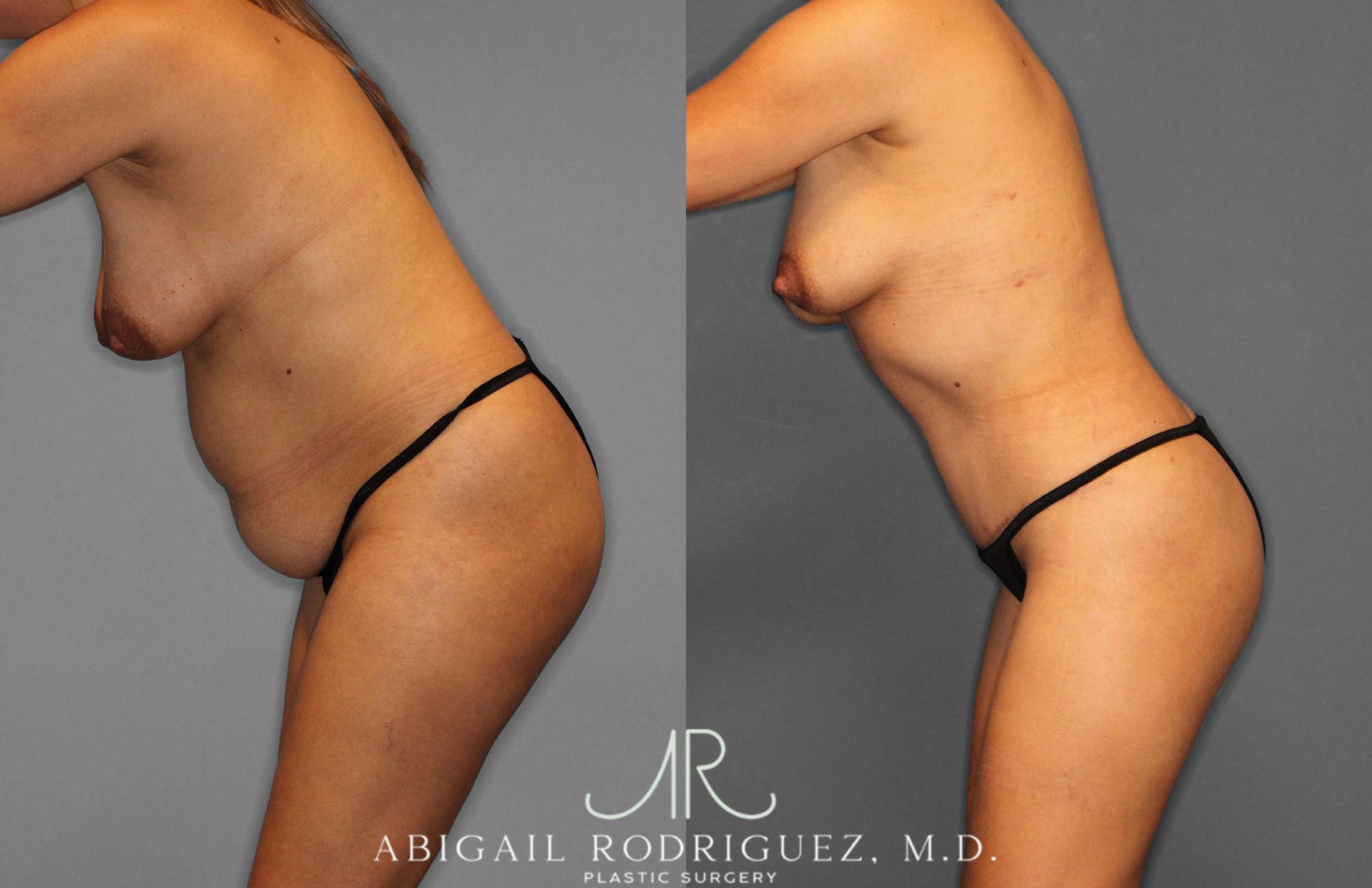 Before & After Tummy Tuck Case 254864 View 4 View in Houston, TX