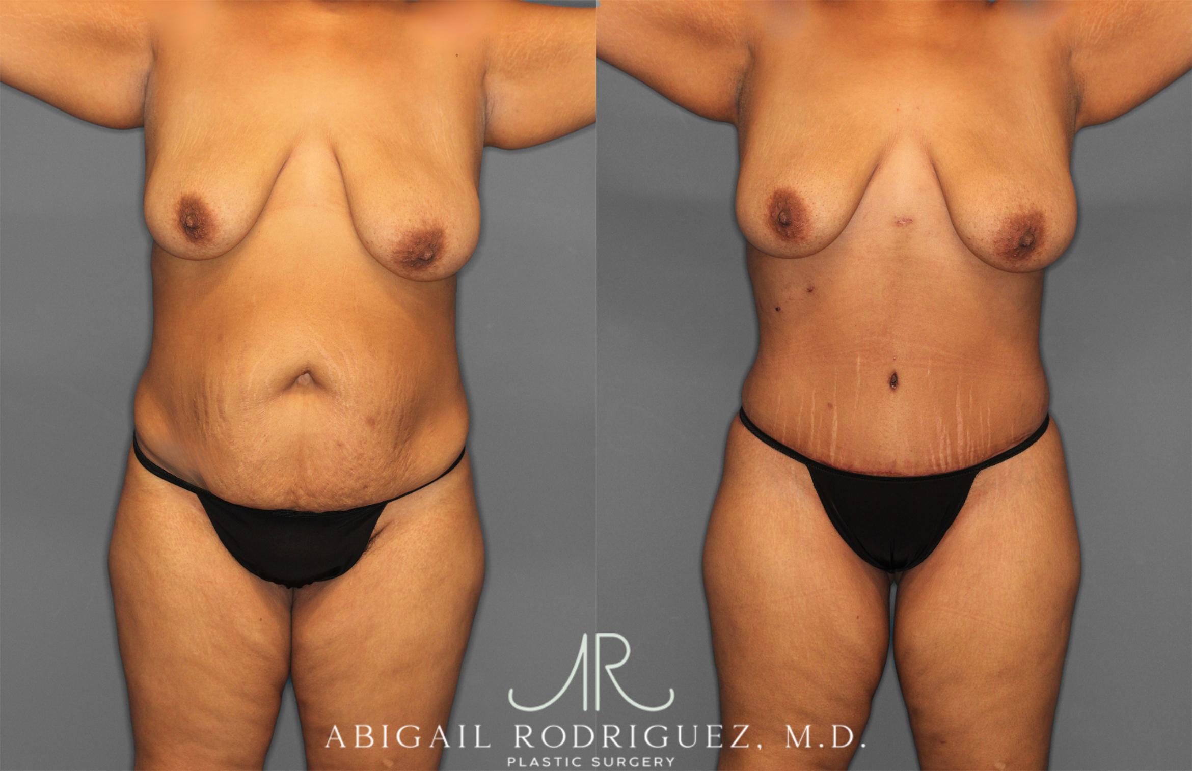 Before & After Tummy Tuck Case 254865 View 1 View in Houston, TX