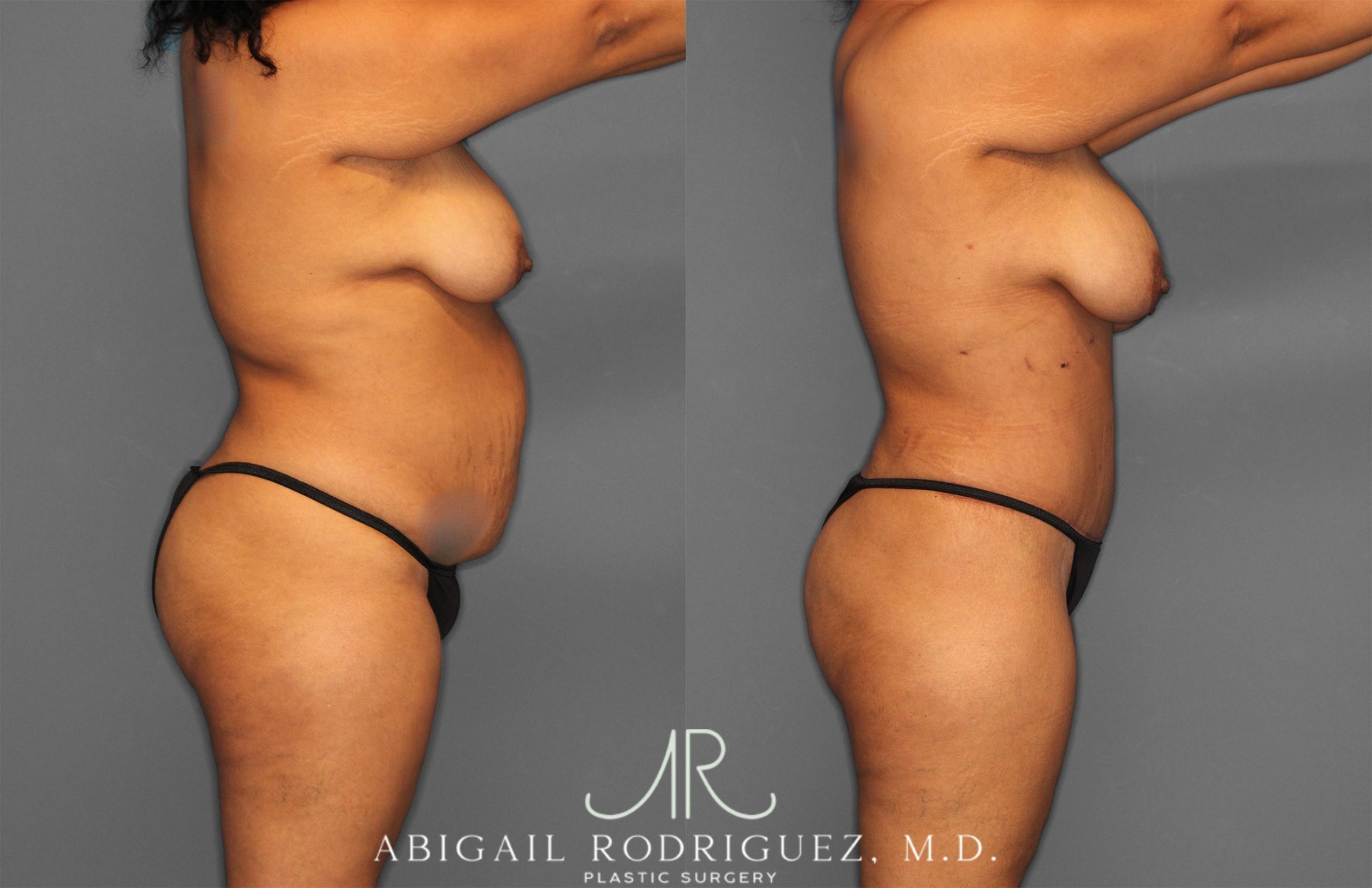 Before & After Tummy Tuck Case 254865 View 2 View in Houston, TX