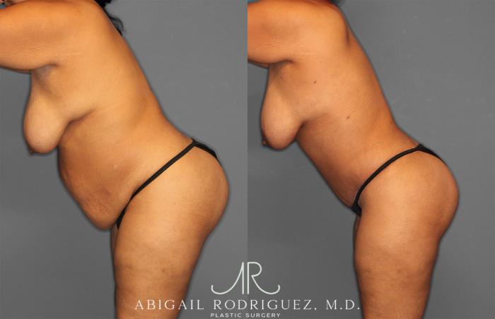 Before & After Tummy Tuck Case 254865 View 3 View in Houston, TX