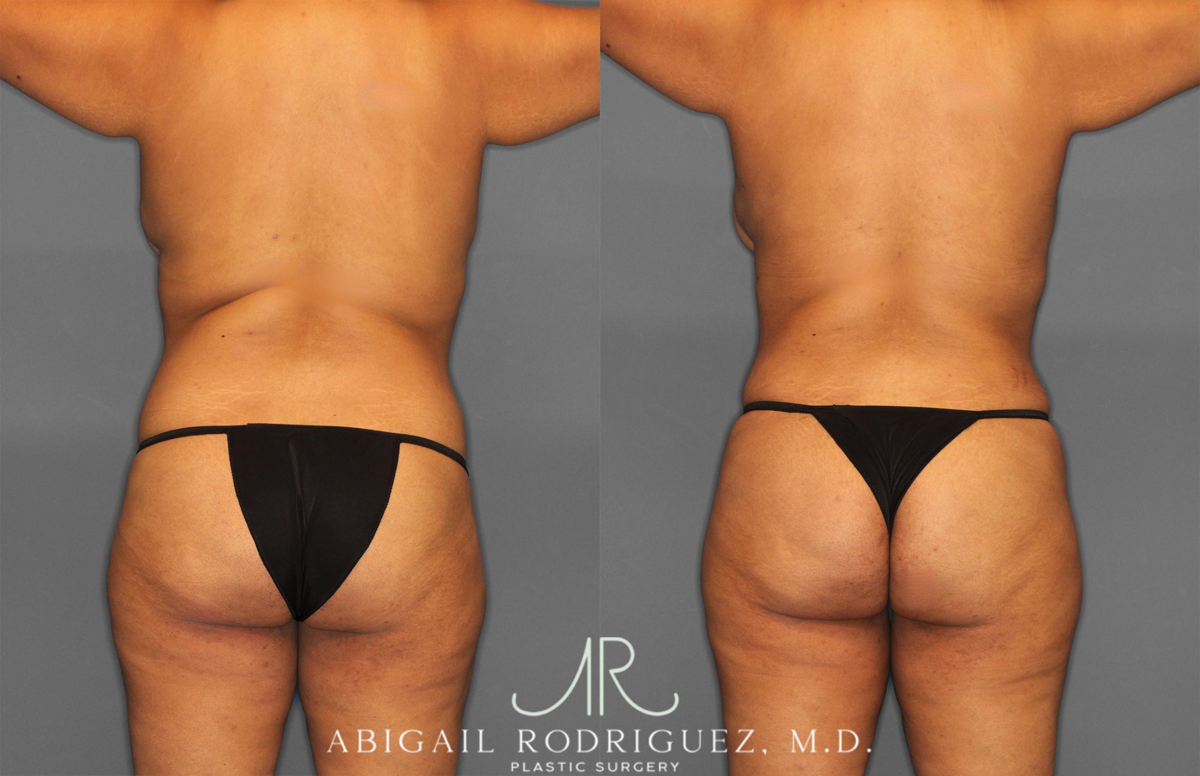 Before & After Tummy Tuck Case 254865 View 4 View in Houston, TX