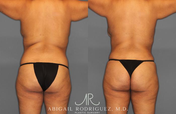 Before & After Tummy Tuck Case 254865 View 4 View in Houston, TX