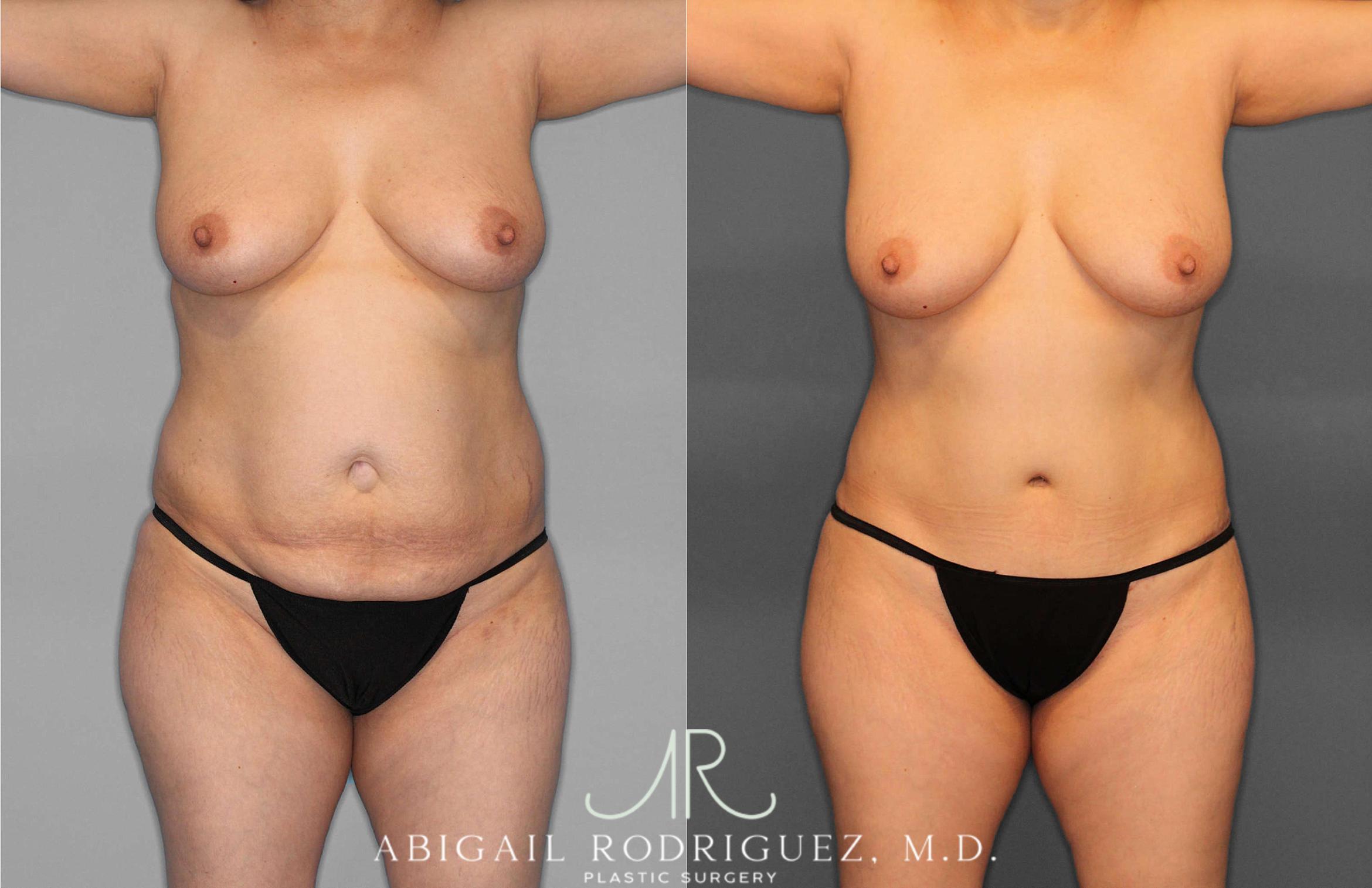 Before & After Tummy Tuck Case 254866 View 1 View in Houston, TX