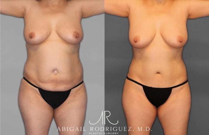 Before & After Tummy Tuck Case 254866 View 1 View in Houston, TX