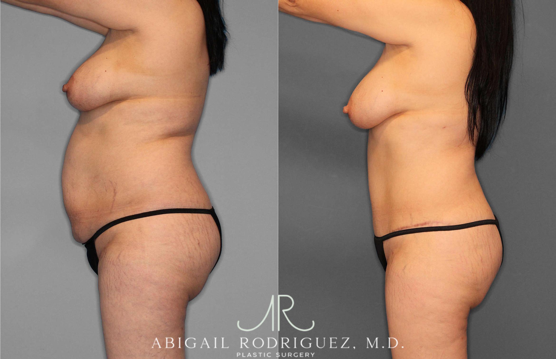 Before & After Tummy Tuck Case 254866 View 2 View in Houston, TX