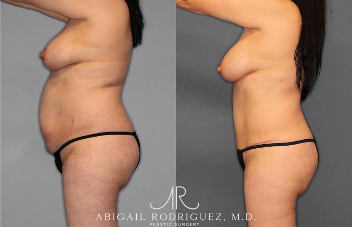 Before & After Tummy Tuck Case 254866 View 2 View in Houston, TX