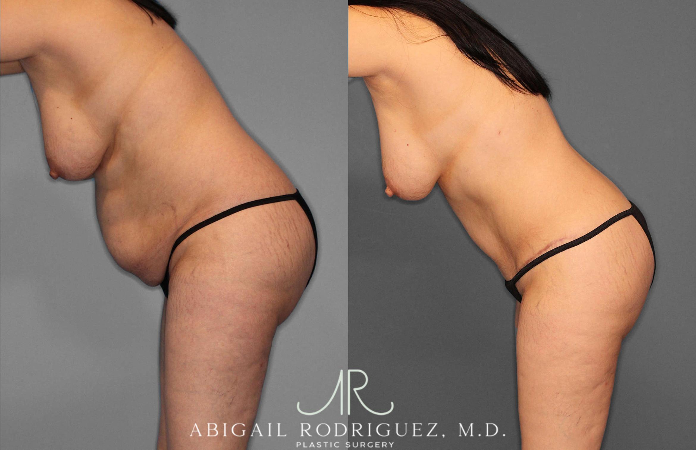 Before & After Tummy Tuck Case 254866 View 3 View in Houston, TX