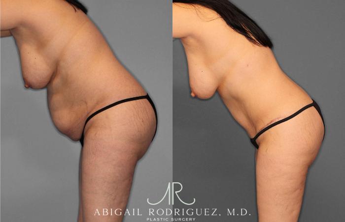 Before & After Tummy Tuck Case 254866 View 3 View in Houston, TX