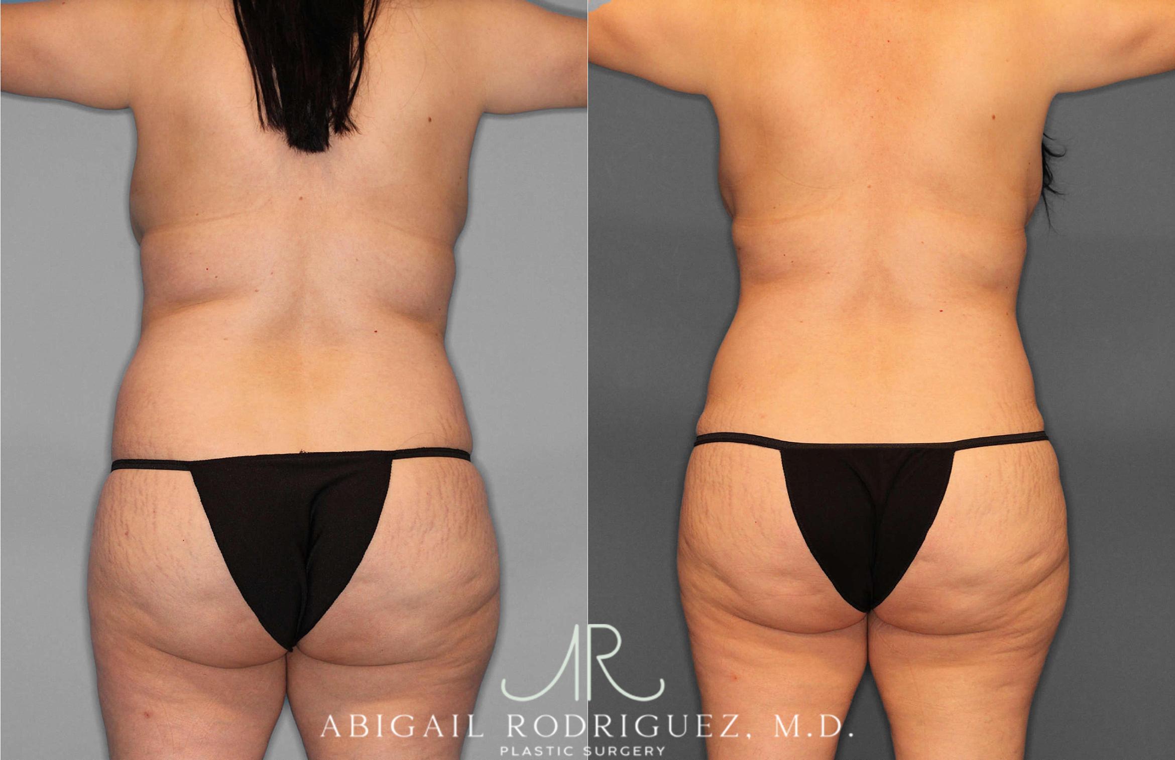 Before & After Tummy Tuck Case 254866 View 4 View in Houston, TX