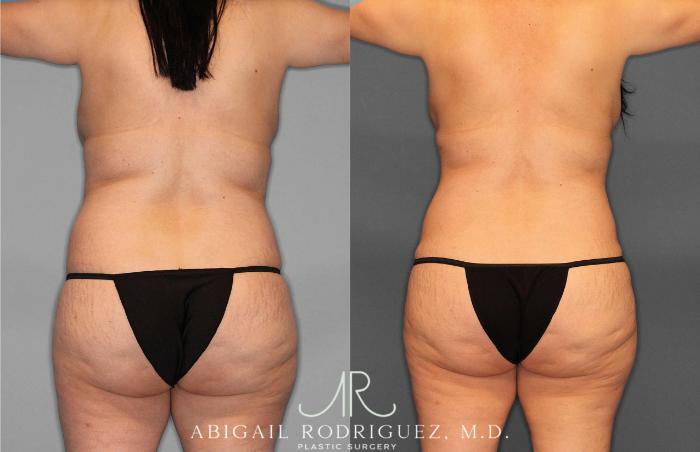 Before & After Tummy Tuck Case 254866 View 4 View in Houston, TX