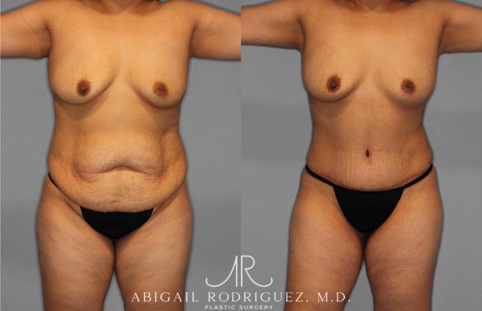 Before & After Liposuction Case 254867 View 1 View in Houston, TX